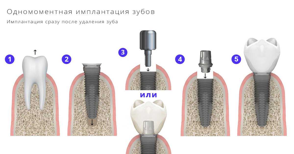 Как не запутаться в таком разнообразии, какие недостатки одноэтапной имплантации бывают, какие отзывы о способах лечения, какую методику выбрать давайте попробуем разобраться со стоматологом, челюстно лицевым хирургом Станевко Дмитрием
