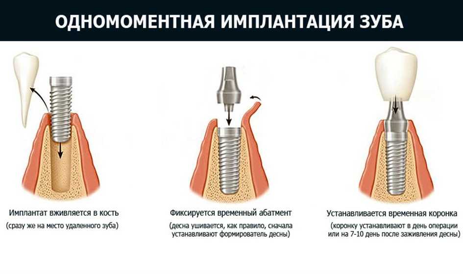 Трезвый взгляд на имплантацию зубов - плюсы и минусы